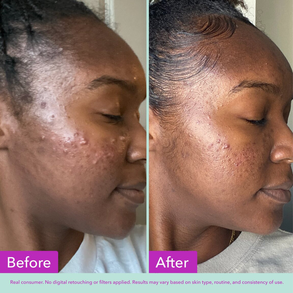 acne-foaming-cleanser-u1 zb_p.jpg